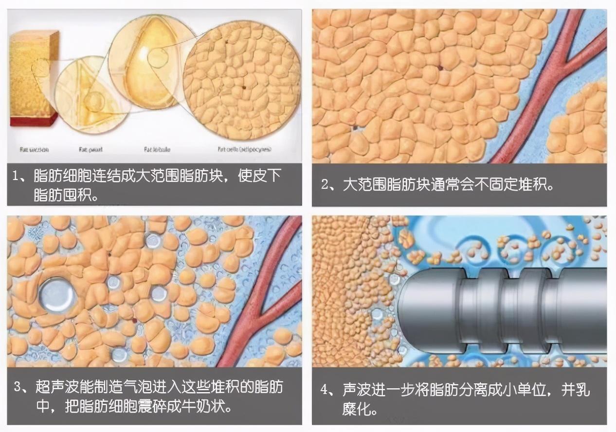 维密脂雕和黄金微雕有什么不一样-普通抽脂和黄金微雕的区别