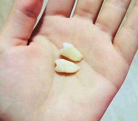 大连齿医生口腔科普矫正一定要拔牙吗还要拔４颗-矫正牙齿拔四颗对人身体有