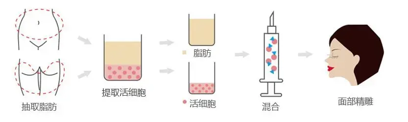 填充面部的自体脂肪，是否能够取出？-脸上可以抽脂肪吗？