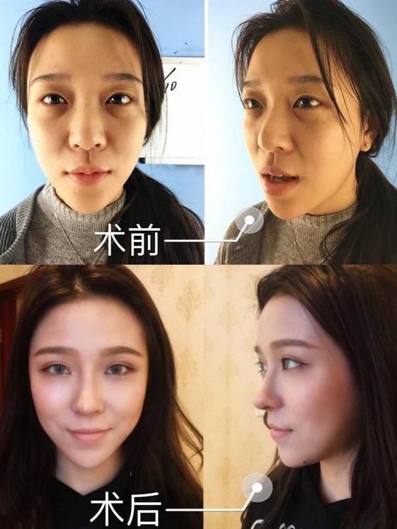 鼻综合材料耳软骨和肋骨选哪个？-肋骨隆鼻疼吗