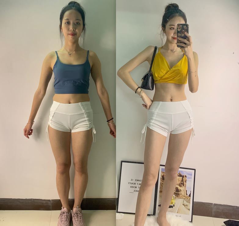 女性变瘦的3个“脂肪肥胖”适合吸脂手术！快看看你能塑形？腹部吸脂手术的价格是多少啊