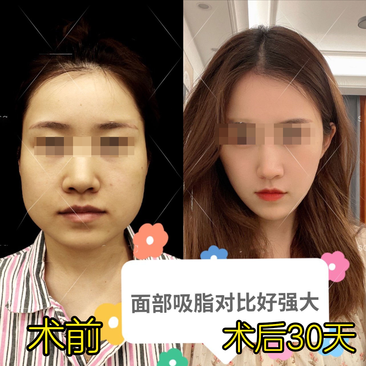 38岁老阿姨面部吸脂30天，闺蜜以为我换了一个头-脸部吸脂大概价钱