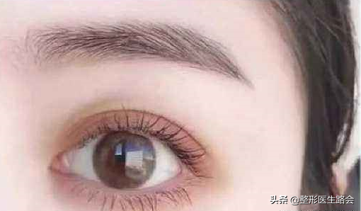 五花八门的双眼皮方法，有可能只是起了个好听的名字-割双眼皮手术的方法有哪些