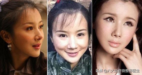 为什么“注射玻尿酸”后会出现“僵尸脸”呢，该如何应对？-玻尿酸突然肿胀怎么回事