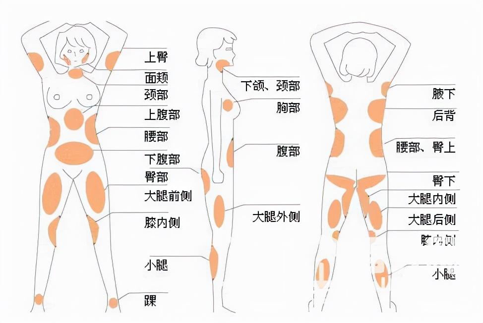 吸脂手术有什么风险？哪些人适合做？-抽脂到底安不安全