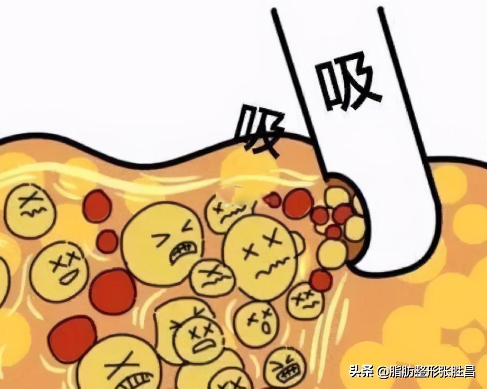 假如我去做抽脂手术，恢复期要多久？安全经历4个阶段即可抽脂妈妈臀要恢复多久