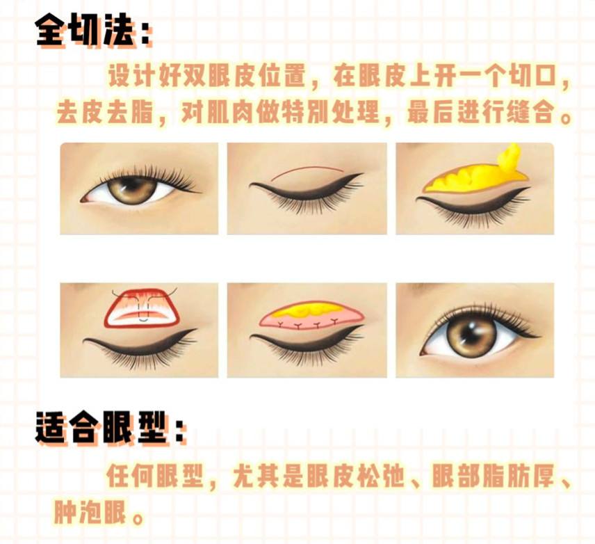 南华博士：全切双眼皮术后会留疤吗？什么情况才需要去做修复？-全切双眼皮可以二次加宽吗