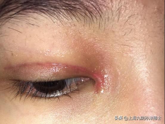 眼修复孙沣博士：双眼皮术后是否会产生疤痕和增生？割了双眼皮增生是什么样子