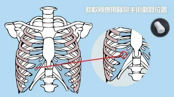 全肋、半肋和全假体鼻综合应该怎么选？-肋骨隆鼻对比效果图