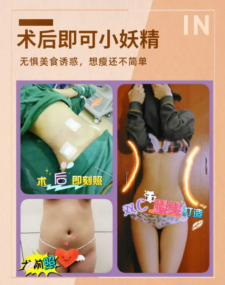 腰腹环吸二三事-环形吸脂减肥多久见效