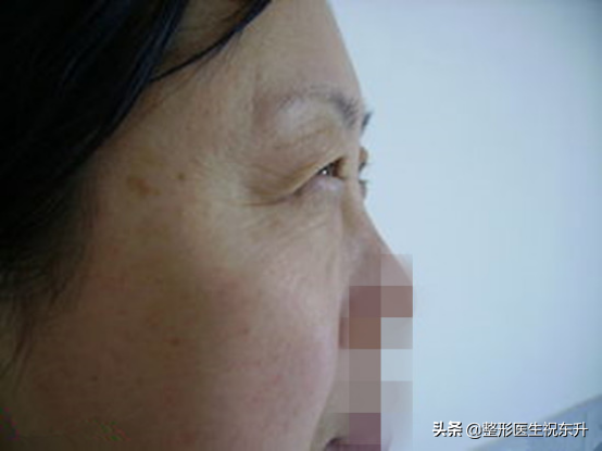 上睑皮肤松弛，医生让做提切眉联合埋线双眼皮，确定不是“坑“我？-割双眼皮好看还是埋线好看图片
