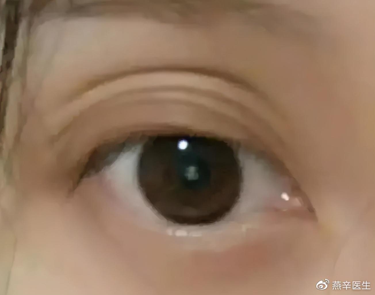 眼皮皱褶多是怎么回事？适合做双眼皮吗？-单眼皮扒开后有褶子是内双吗还是外双