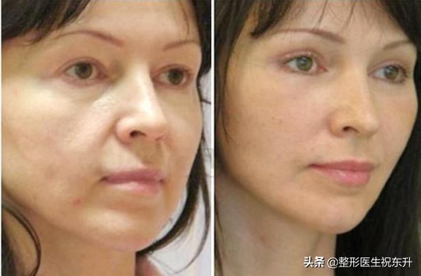 关于“面部脂肪填充”，医生想与你说几句实话-脂肪填充怎样才能存活率高