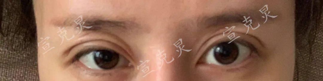 【惊悚！】双眼皮修复成“三眼皮”爱美整容反遭“毁容”-三眼皮割双眼皮手术要多少钱