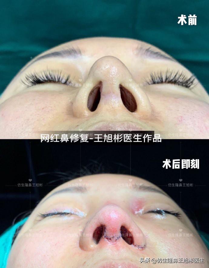 科普：鼻中隔延伸移植在鼻尖轮廓中的作用-鼻中隔软骨做鼻尖