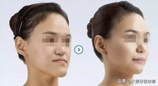 “地包天”的最佳治疗时间是什么？-地包天牙齿矫正年龄注意什么