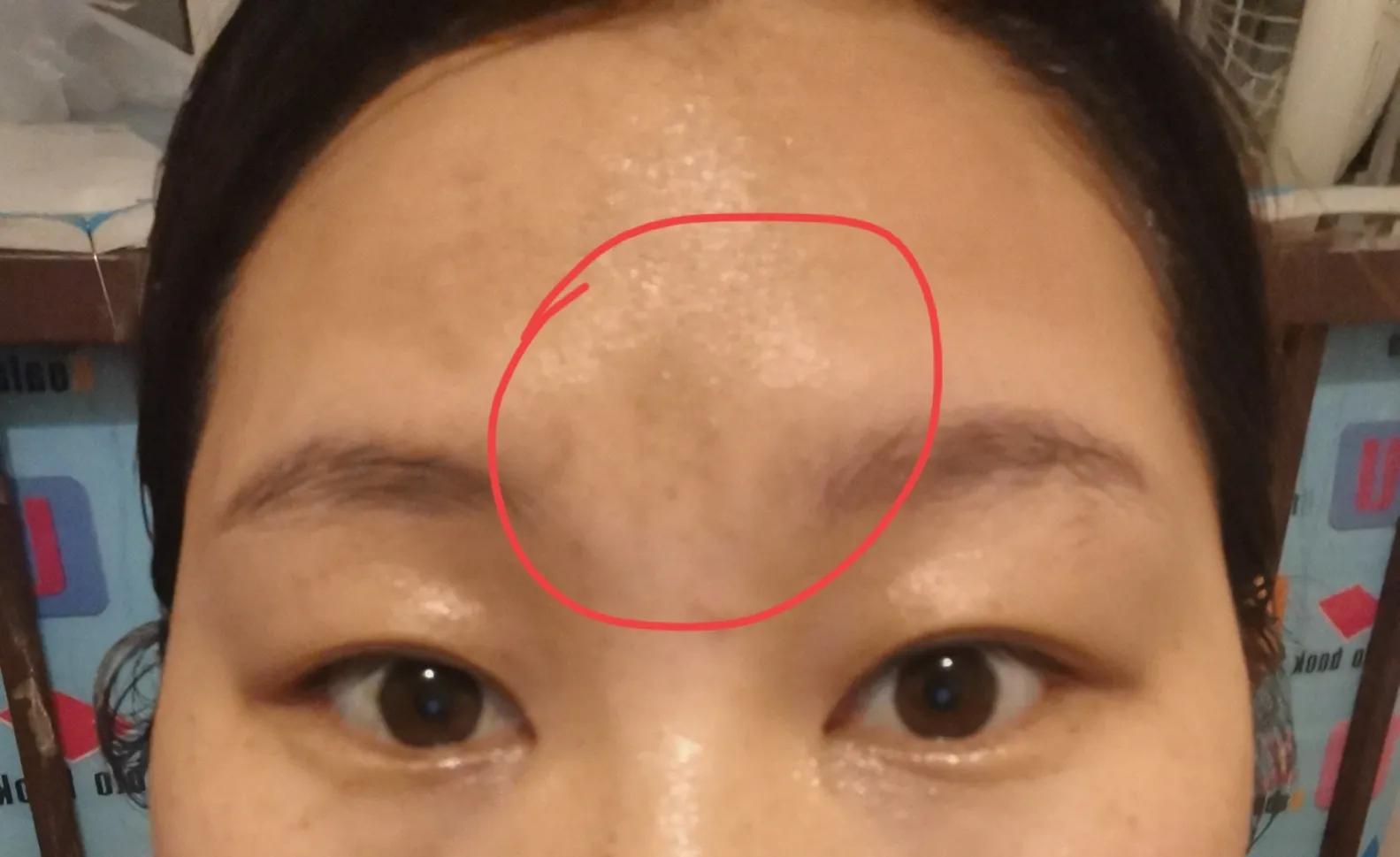 这是一篇求救帖，玻尿酸能打嘛？-打玻尿酸针要多少钱一针