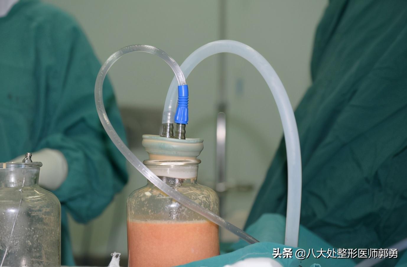 是不是任何一个肥胖部位都可以吸脂呢？-抽脂一次可以做几个部位
