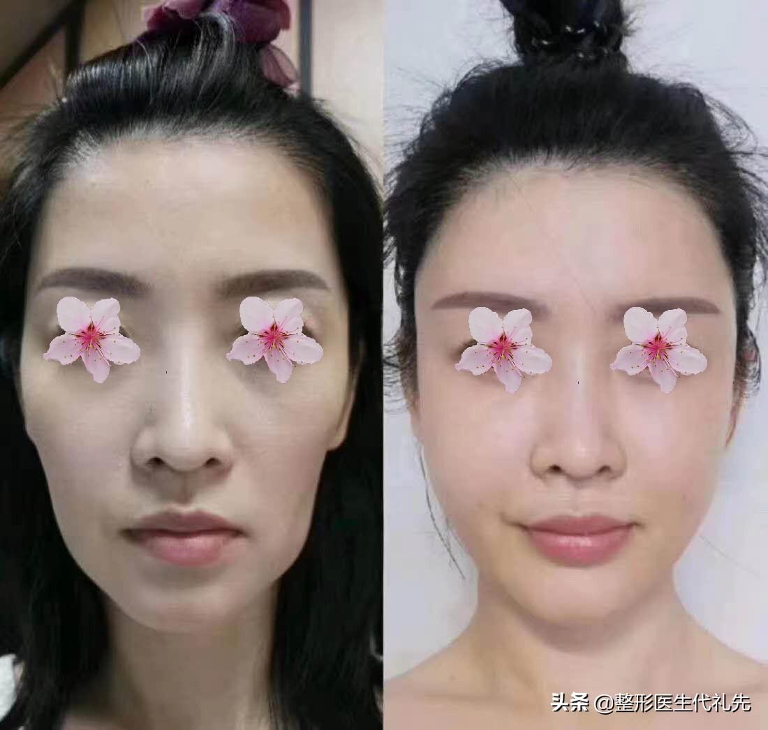 做脂肪填充之后，会下垂得更厉害？更容易显老？准备做面填来看看-自体脂肪填充以后会老得快吗