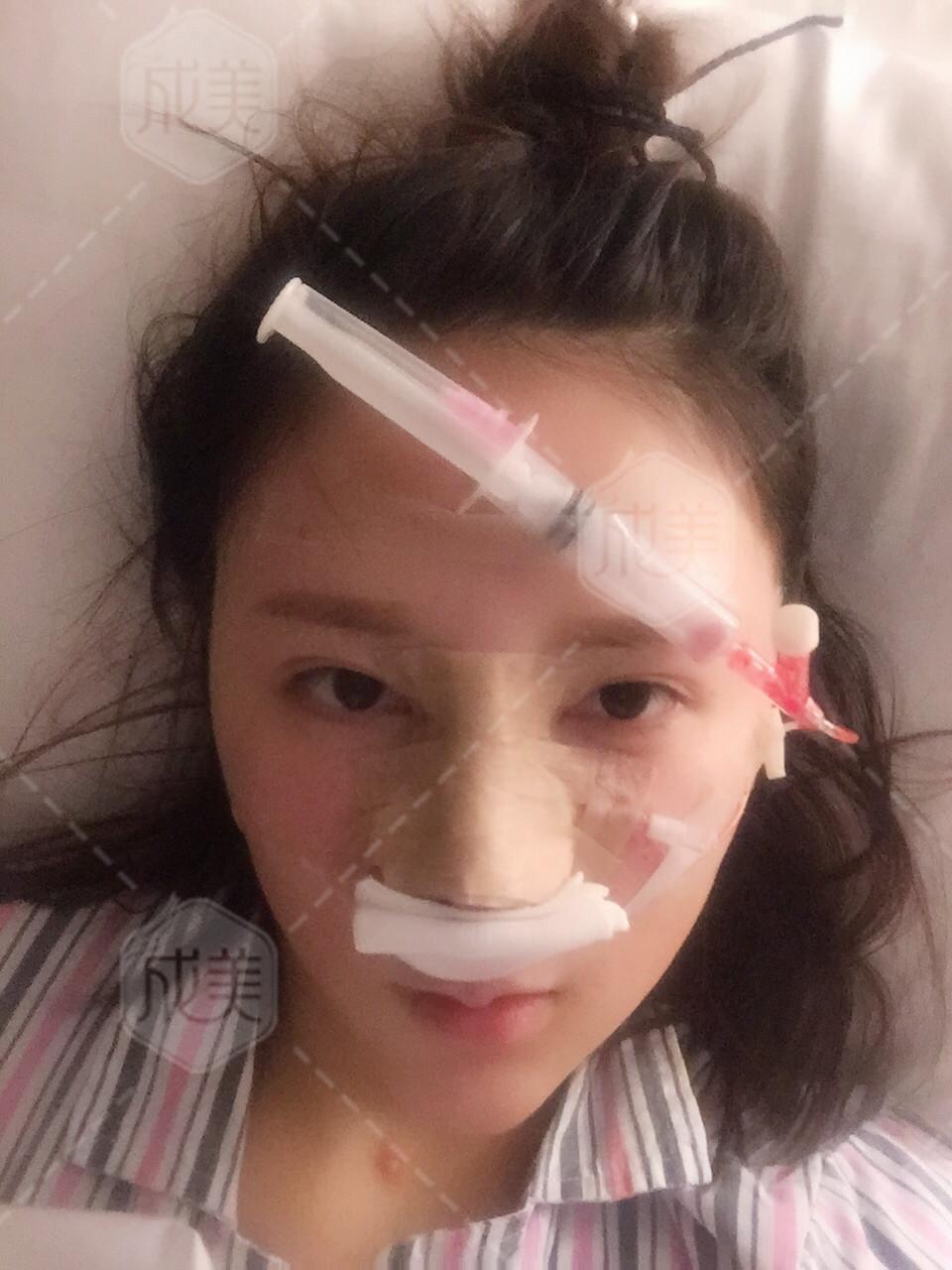 隆鼻术后一周护理#成都隆鼻#-隆鼻拆线疼不疼要多久