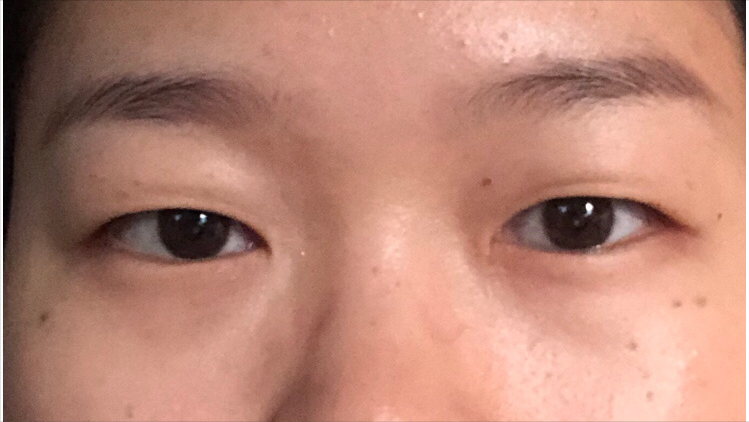 做个双眼皮要花1.5w元钱？为什么别人几百块就行？医生告诉您-做双眼皮一般要价格实