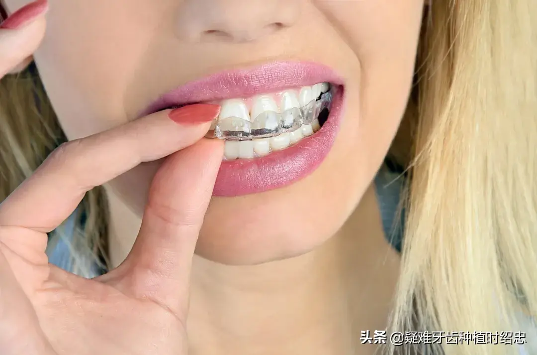 隐形矫正牙齿花费时间比传统矫正时间长吗？-隐形纠正牙型大概多少钱