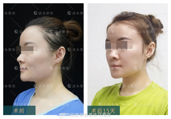 方案：面部吸脂-抽脂面部的价格