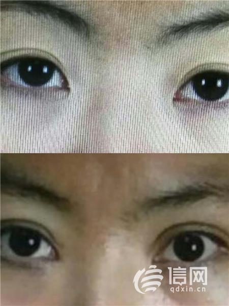 做了双眼皮手术后却闭不上眼诺德医院：还在恢复期-割双眼皮修复手术医院能做吗