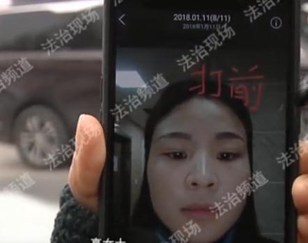 女子打了瘦脸针，脸部却意外“凹陷”，有关部门：不能在此行医！-打瘦脸针安全吗？