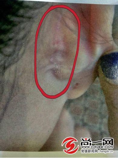女子花4万隆鼻，术后发现耳软骨竟“消失”了...-耳软骨隆鼻多少钱？