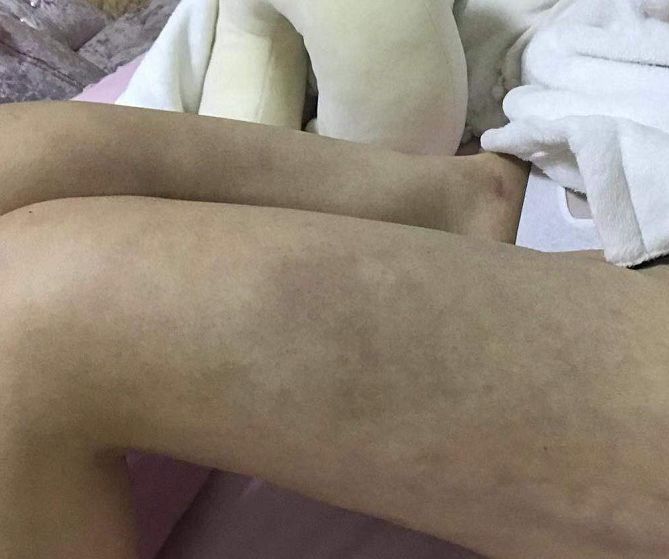 女子做抽脂手术后腿“惨不忍睹”，南昌亚太医疗美容医院这么回应-大腿抽脂危及生命吗会疼吗