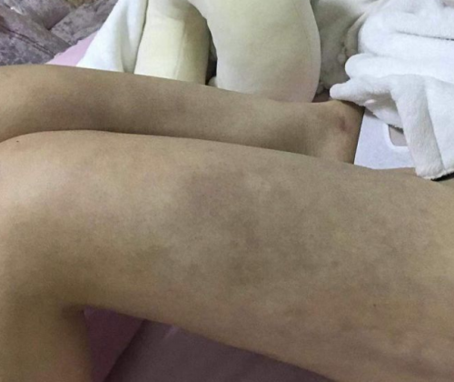 女子在南昌亚太医疗美容医院做抽脂术后“惨不忍睹”腿疼凹陷淤青-抽脂肚子疼还是腿疼