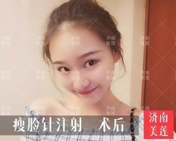 注射肉毒素24小时内三件事情绝对不能做打瘦脸针前一天喝酒有影响吗