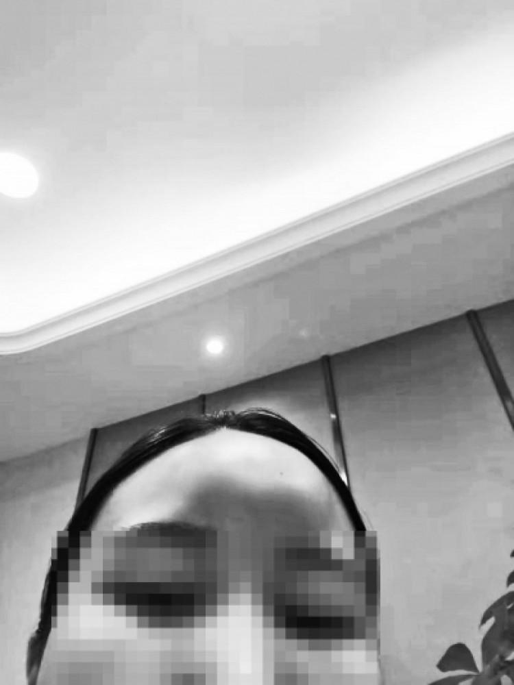 女大学生整形失败注射玻尿酸后额头变成“寿星脑”-玻尿酸丰额头多久能恢复自然