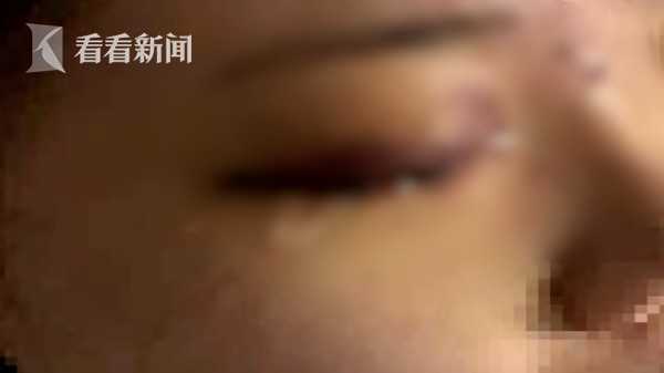 19岁女孩爱美打玻尿酸隆鼻一针下去眼睛失明了-鼻尖打玻尿酸会栓塞吗