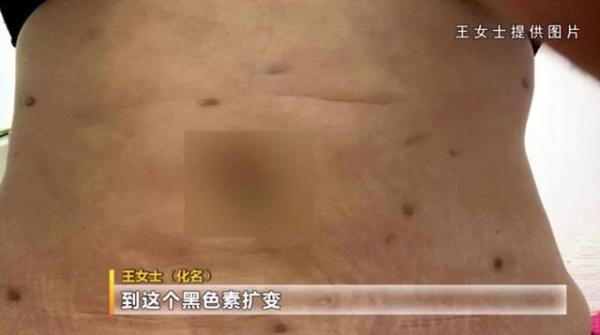68万做“抽脂术”女子浑身长满黑色疤痕后悔也来不及了-美容抽脂多少钱一次合适