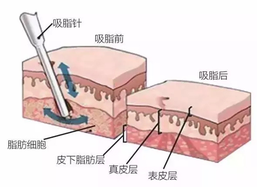吸脂手术后遗症及其反弹问题是怎么回事？-抽脂手术有什么副作用吗女性