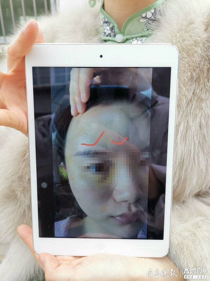 买一送一？脸部整形送鼻填充，两万多做的整形，咋俩月就没了效果-隆鼻针多少钱