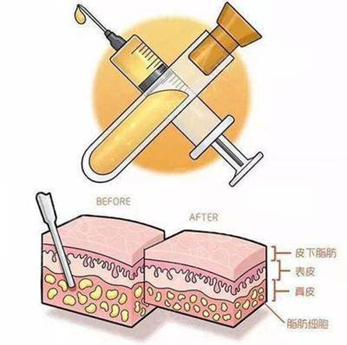 韩啸医生解析不恰当吸脂会引发哪些后遗症？-抽脂术后后遗症