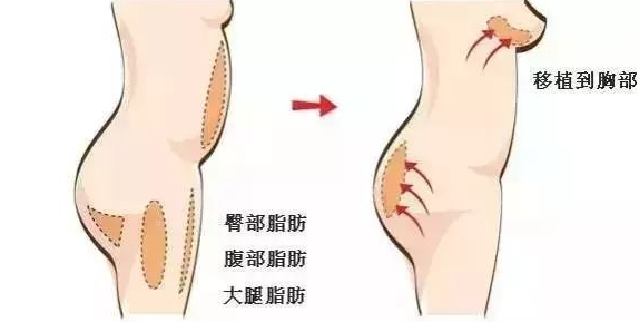 自体脂肪丰胸手术的四大误区，小心被误导-自体脂肪注射移植