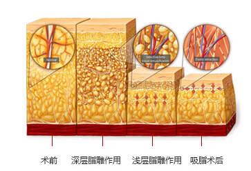 吸脂手术安全吗？术后有没有后遗症？-抽脂手术有效果吗