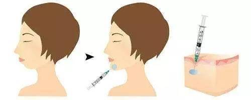 玻尿酸的作用是什么？注射完之后有哪些方面是需要注意的-玻尿酸隆鼻注射后多久塑形效果最好