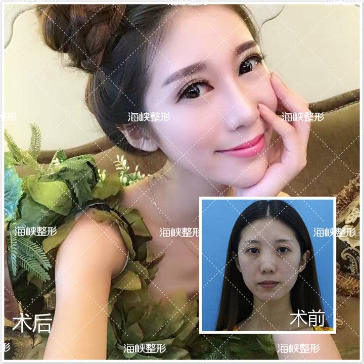明明打了瘦脸针，脸为什么还这样大？-打瘦脸针几针可以定型