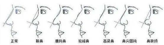 鼻子过短怎么整？-短鼻子适合隆鼻吗