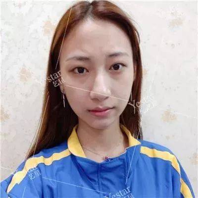 济南艺星双眼皮怎么样？看她就够了！（清纯女大学生秒脱单）-开双眼皮需要多少钱艺星