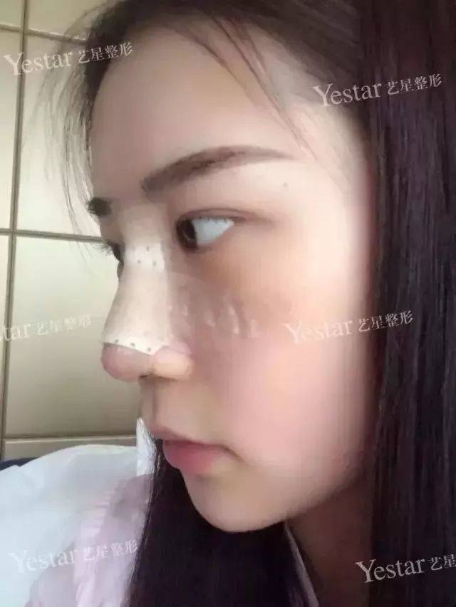 「济南艺星科普」隆鼻后多久才能看不出痕迹？-隆鼻疼吗需要多长时间恢复