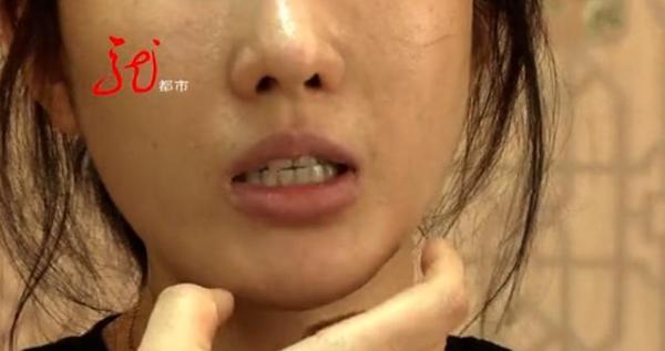 打了13针瘦脸针，女子半边脸斜了，下巴也歪了！连笑都不会了-瘦脸针的危害性
