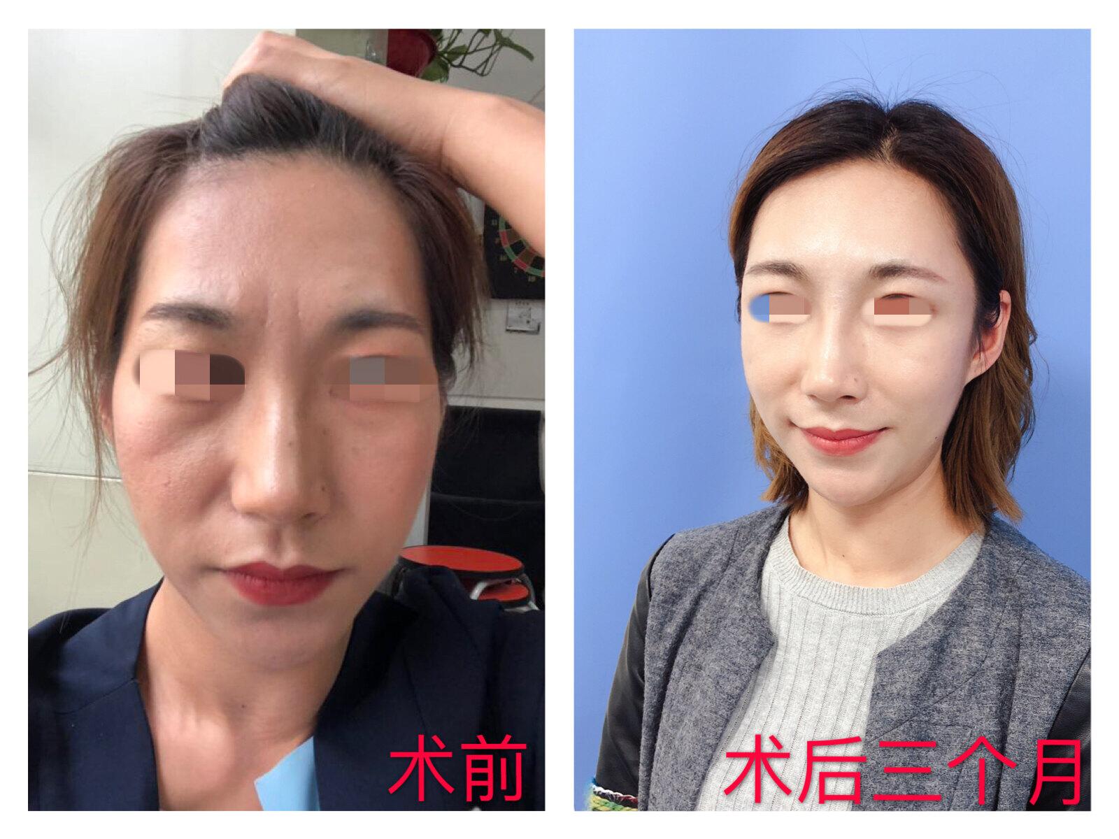 自体脂肪填充面部几天能恢复-二次填充脂肪恢复期长多久