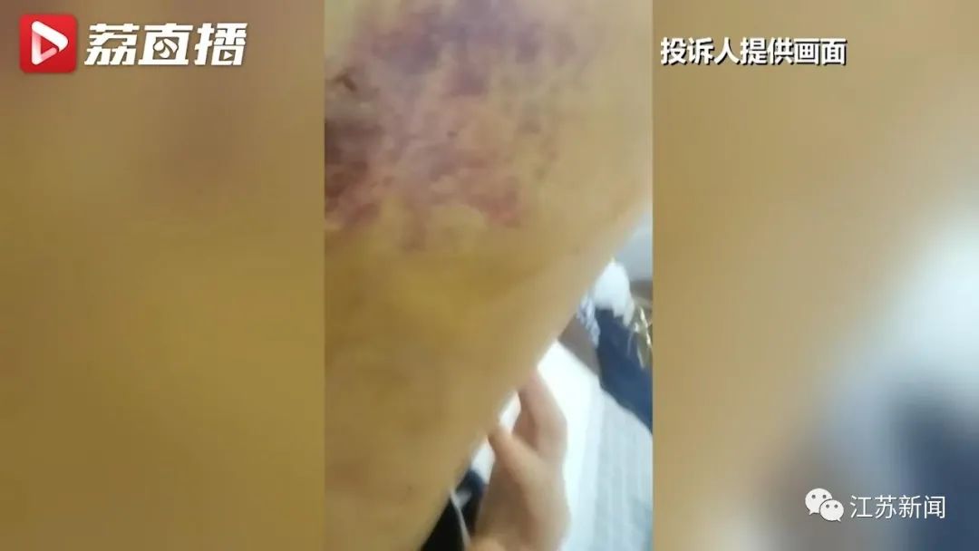 花6万元吸脂后皮肤坏死，双腿凹凸不平！还没修复好，整形医院去哪了？-大腿抽脂手术费用