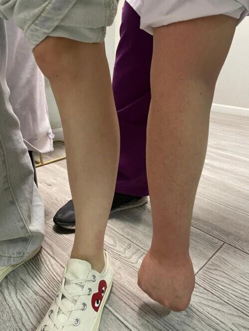 80多斤女孩要吸脂瘦腿被医生劝退：我的前臂都比你小腿粗-大腿吸脂有风险吗